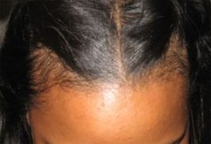 Hair Loss After Pregnancy